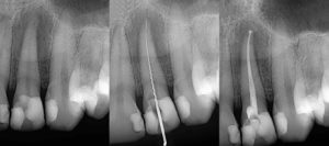 Before and after Endo treatment Dental X-ray