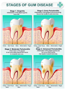 Stage of Gum Disease
