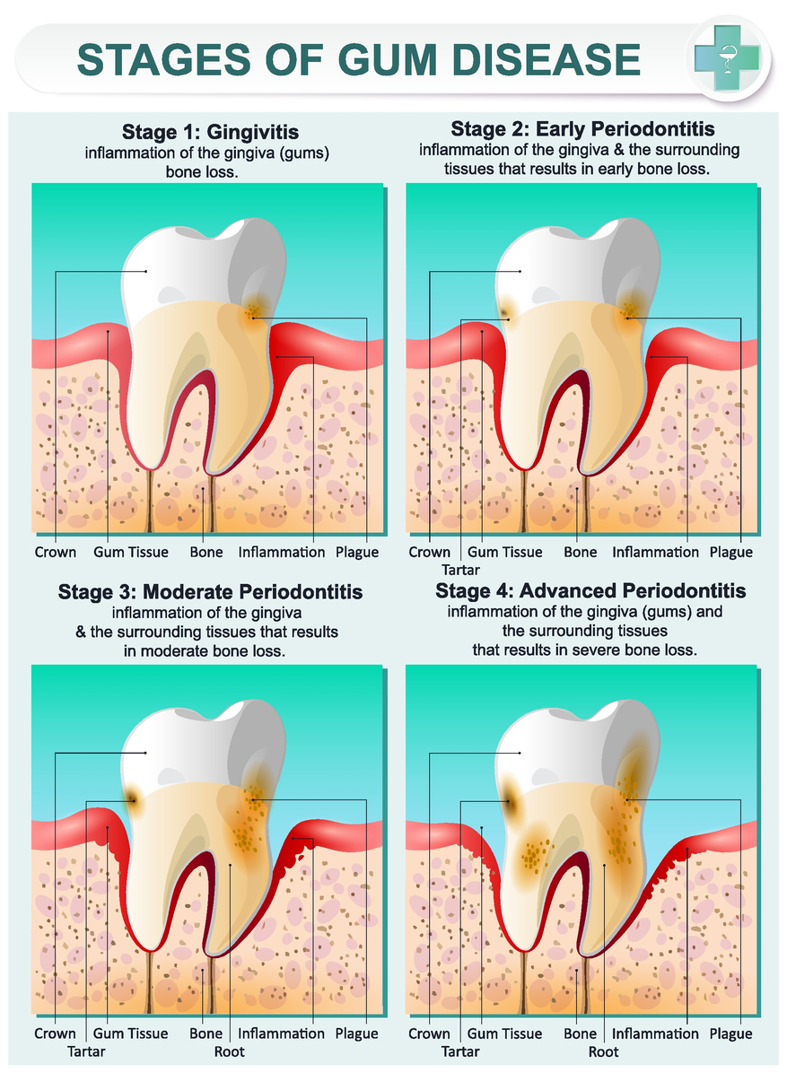 Stage of Gum Disease