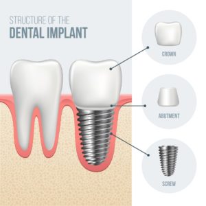Crown Implant