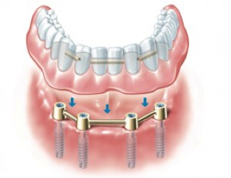 implantdenture